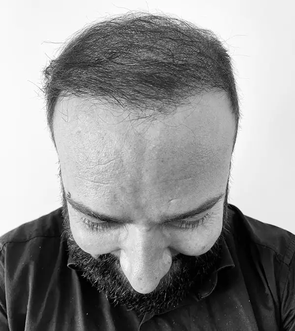 Klient po zákroku implantace vlasů